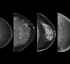 Example of the four types of breast tissue density. The density of fibroglandular tissue inside the breast impacts the ability to easily see cancers. Cancers are very easy to spot in fatty breasts, but are almost impossible to find in extremely dense breasts. These examples show craniocaudal mammogram findings characterized as almost entirely fatty (far left), scattered areas of fibroglandular density (second from left), heterogeneously dense (second from right), and extremely dense (far right). RSNA